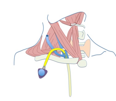図１２　Atlas surgery での内頚静脈アプローチでの CV ポート埋設術