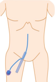 図１４　大腿静脈アプローチでの、大腿遠位部へのCVポート埋設術