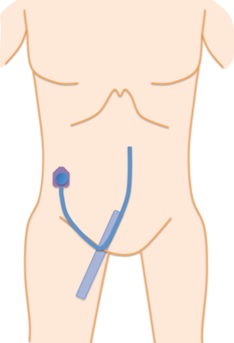 図１５　大腿静脈アプローチでの、腹壁へのCVポート埋設術：（筆者作成のイラスト）