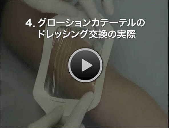 4.グローションカテーテルのドレッシング交換の実際-クリックで再生