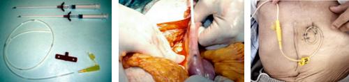 図３　開腹術による穿刺式カテーテル空腸瘻造設術 needle catheter jejunostomy