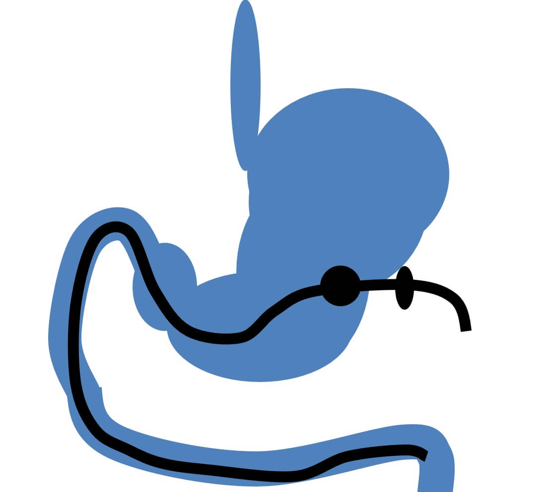 図8　経胃瘻的小腸挿管（PEGJ）