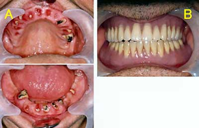 写真2　咬合の回復、A：咬合の回復前、B：咬合の回復後（残根歯牙を抜歯し義歯を装着）