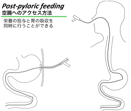 図１　Post-pyloric feeding　空腸へのアクセス方法