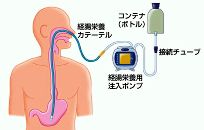 図１　経腸栄養療法に必要な器具