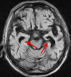 図１　アルツハイマー病患者の頭部MRI