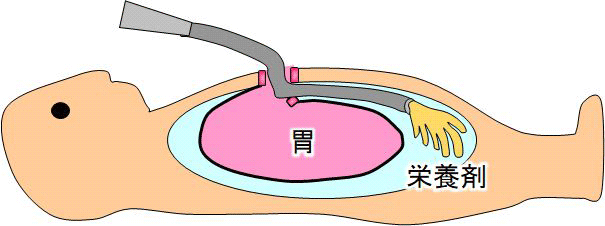 図１　胃瘻カテーテル挿入後の腹腔内誤挿入