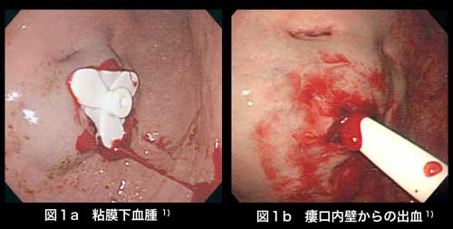 カテーテル挿入部の粘膜下血腫(図１a)、瘻孔内壁からの出血(図１b)