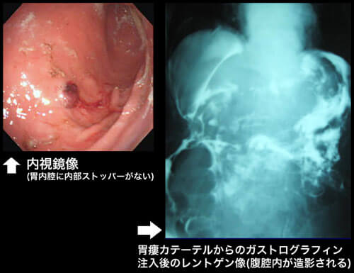 図４　腹腔内誤挿入時の画像診断
