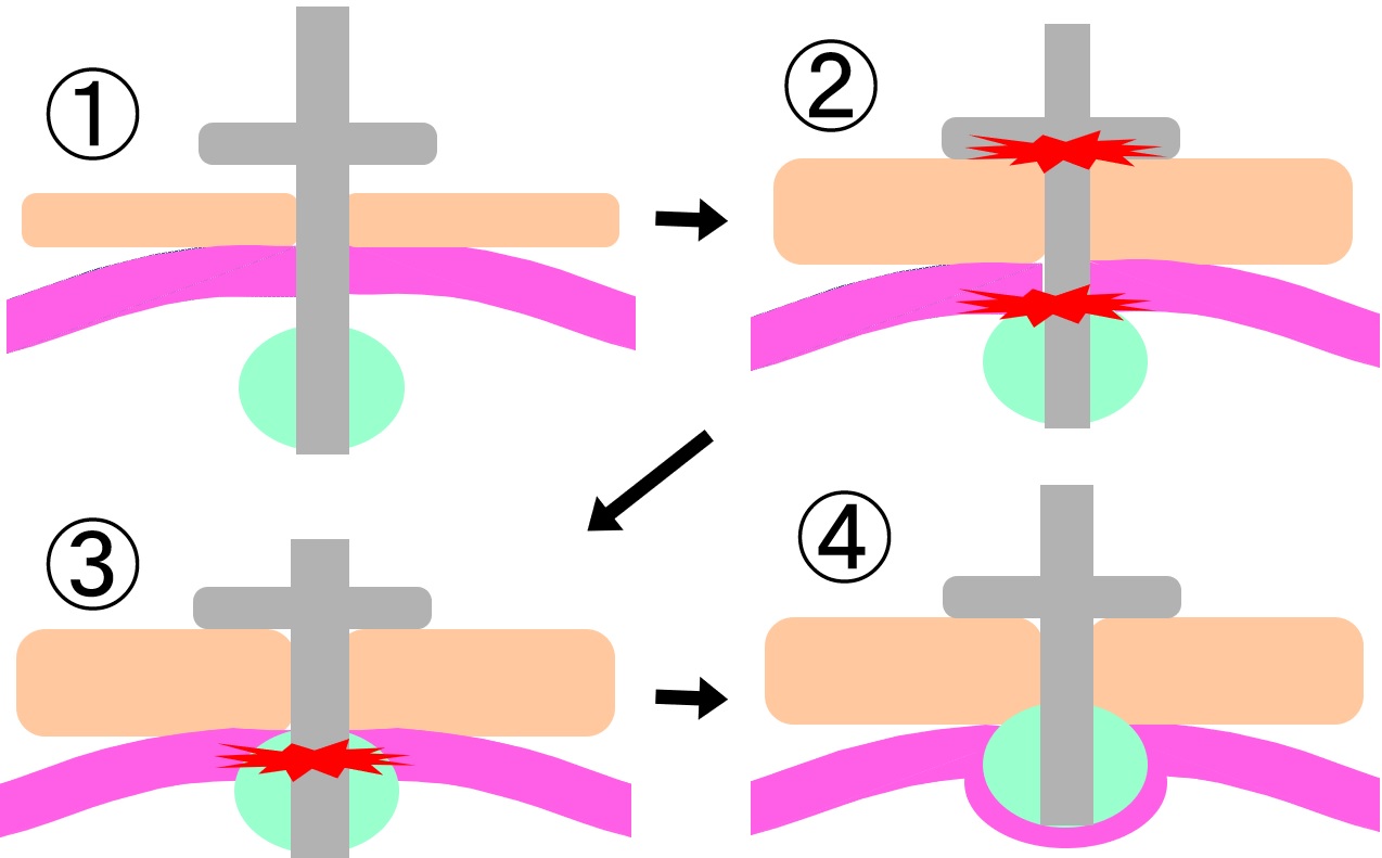 図6　バンパー埋没症候群の発生機序
