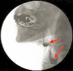写真1　造影画像、矢印は造影剤の咽頭残留